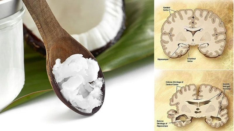 Ist Kokosöl wirksam gegen Alzheimer?